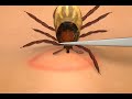 How To Remove A Tick