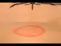 How To Remove A Tick