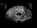 Baby Ultrasound early pregnancy 5,6,7,8,9 weeks 3D