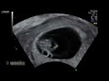 Baby Ultrasound early pregnancy 5,6,7,8,9 weeks 3D
