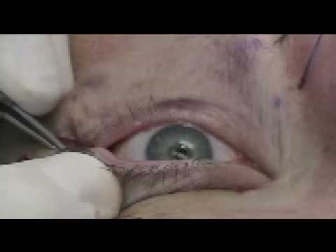 Lower Eyelid Laser Surgery - Blepharoplasty