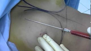 Tuberous Breast Correction Using Coleman Fat Grafting