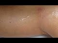 Video: Spider Veins Laser Treatment-Fotona Nd:Yag 1064 nm Laser