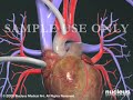 Heart Bypass Surgery (CABG)