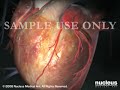 Heart Bypass Surgery (CABG)