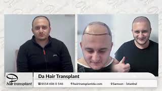 Saç ekiminde tercihi DA Hair Transplant oldu! Operasyon sürecini paylaştı