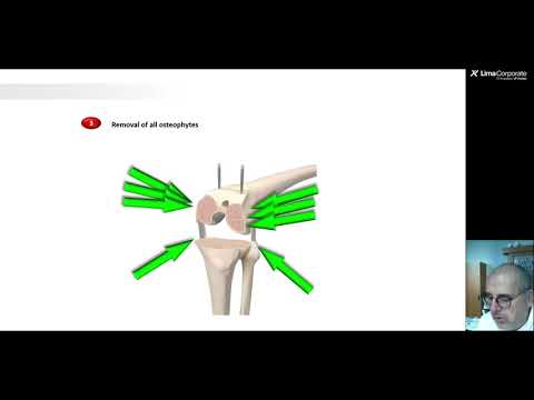 Il bilanciamento dei legamenti nell’artroplastica totale di ginocchio - il Physica system Balancer thumbnail