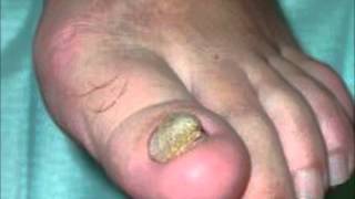 Los ungüentos para el tratamiento del hongo en la zona inguinal