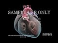 Aortic Valve Replacement