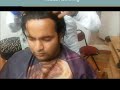 advanced technology in bangalore for permanant hair replacement hair fixing hair bonding