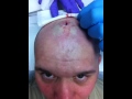 Horn removal