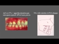 Treatment of class 2 division 2 malocclusion