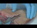 Suture - Basic Technique 1