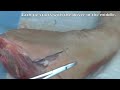 Suture - Basic Technique 1