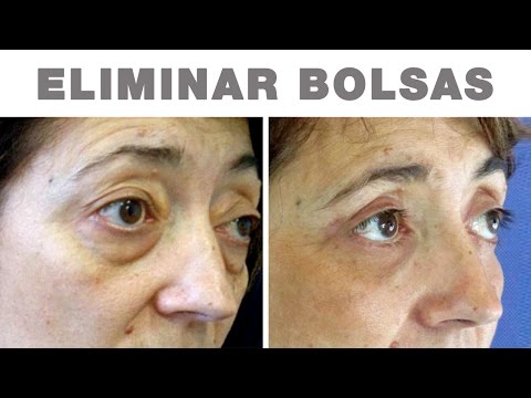 Las arrugas de edad bajo los ojos