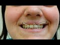 THE TOOTH - tannversjon av Ylvis