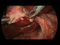 Laparoscopic Cholecystectomy (Gallbladder) Surgery