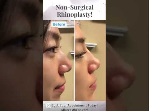 NON SURGICAL NOSE JOB! NO surgery NO downtime! Before and After