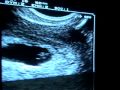 Pregnancy 5.6 weeks - Embarazo 5.6 semanas