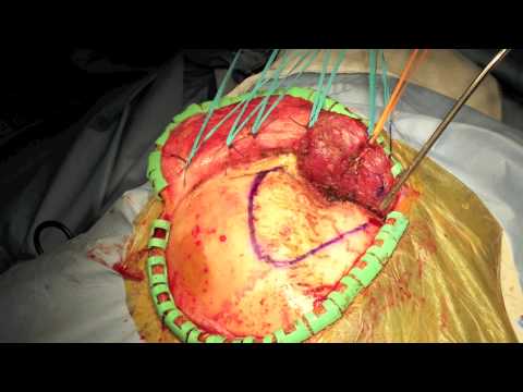 pterional craniotomy