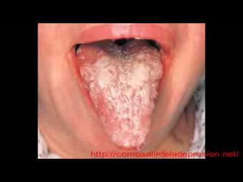 COMBATIR CANDIDA ALBICANS combatir candida albicans: