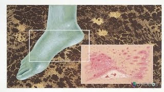 El hongo de las uñas en las manos el tratamiento los preparados eficaz