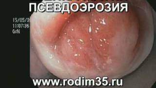 esli pri sdat virus na erozii papilloma analiz to chto Сдать анализ на папиллома вирус при эрозии фото