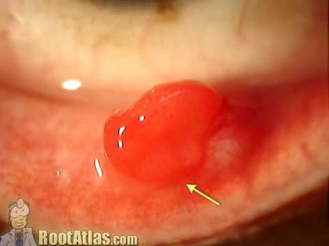 stye on eyelid. Pyogenic Granuloma on Eyelid