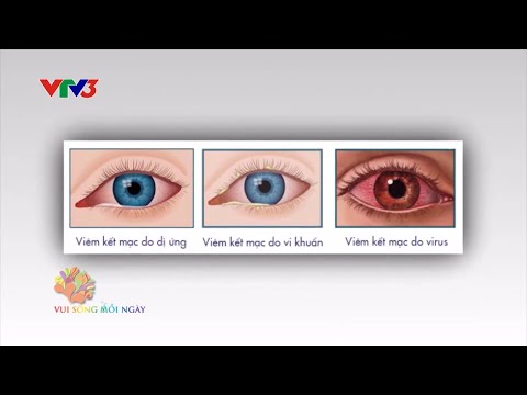 Mùa hè, vì sao trẻ hay bị lên lẹo ở mắt?