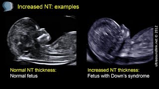 Translucency gender nuchal test Noninvasive Prenatal
