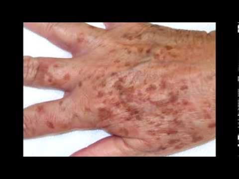 La máscara de las manchas de pigmento belita