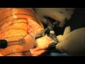Total Knee Replacement Surgery 2011 - HD