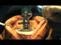 Total Knee Replacement Surgery 2011 - HD