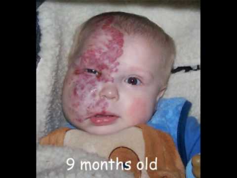 Hemangiomas have a characteristic clinical course marked by early Hemangiomas have a characteristic clinical course marked by early
