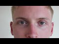 Examination of the Eye & Vision - OSCE Guide