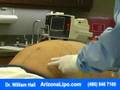 Liposuction Procedure with Dr. William Hall - Abdomen Waist view on youtube.com tube online. Liposuction Procedure with Dr. William Hall - Abdomen Waist view on youtube.com tube online.
