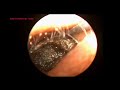 IMPACTED EAR WAX THREE YEAR OLD CHILD REMOVAL BY A SPECALIST