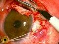 Intraocular tumor Surgery, Melanoma