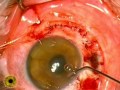 Intraocular tumor Surgery, Melanoma