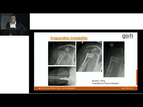 MO.S.A.I.C. Relive: Reverse Shoulder Arthroplasty (RSA) Indications and Operative Technique thumbnail