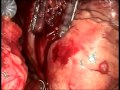 Bypass Surgery on a Beating Heart. Arie Blitz, MD, FACC