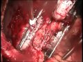Bypass Surgery on a Beating Heart. Arie Blitz, MD, FACC