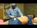 Video: Laser Liposuction-SmartLipo-Belly-Love handles-Huntington Beach-Hacienda Heights