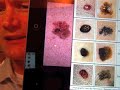 Mole vs Melanoma
