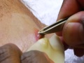 Bot Fly Removal