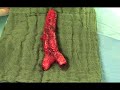 Surgical Reconstruction for Male-to-Female Sex Reassignment
