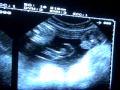 38 weeks Pregnant: It´s a boy !! - Gestación 38 semanas: Es un niño!!