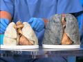 How Smoking Affects the Body on 'The Doctors'
