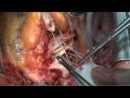 Lehrvideo: Offene Herz OP - Aortenklappen Rekonstruktion - open heart surgery - Herz Operation