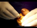 Artrodesi IFP II dito con Smart Toe